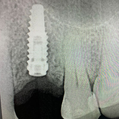 implant2